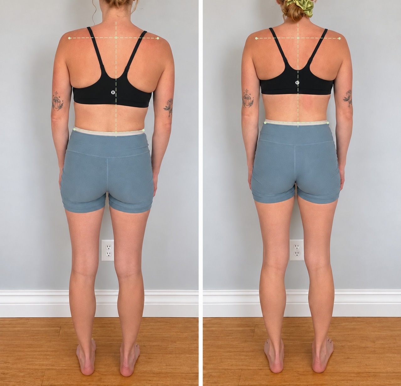 Spinal Decompression & Hip Balance — Before and After
